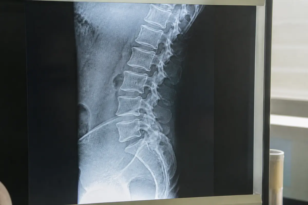 Antélisthésis de L5 sur S1 : Comment soulager la douleur ?