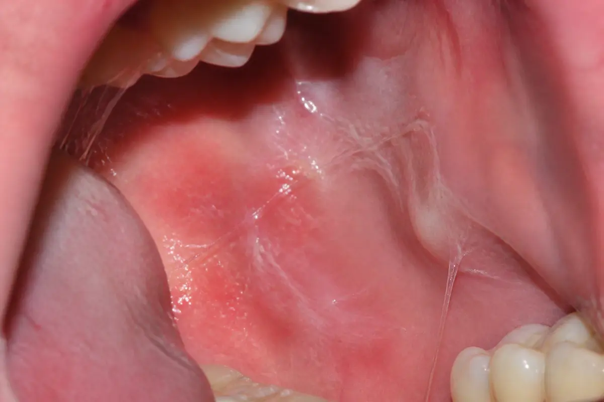 Filaments blancs dans la bouche : causes, dangers et solutions ?
