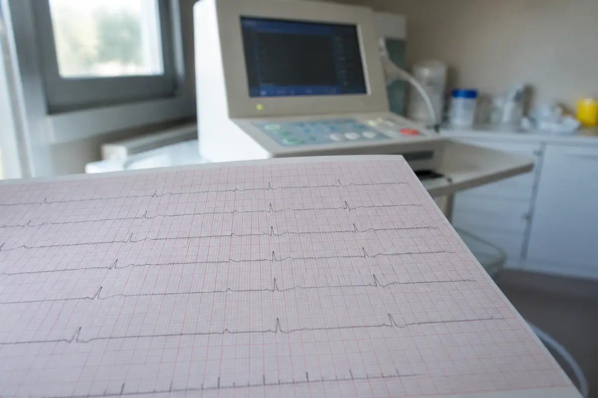 Hypercalcémie ECG : guide pratique de l’interprétation cardiaque